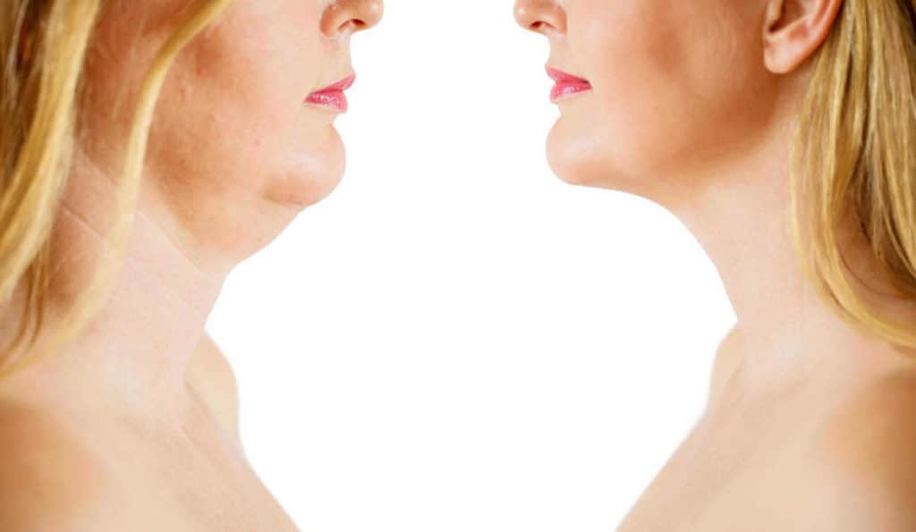 Double Chin treatment Llanelli before and after results