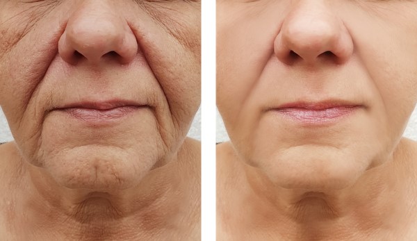 Learn more about Morpheus8 Treatment Llanelli today!