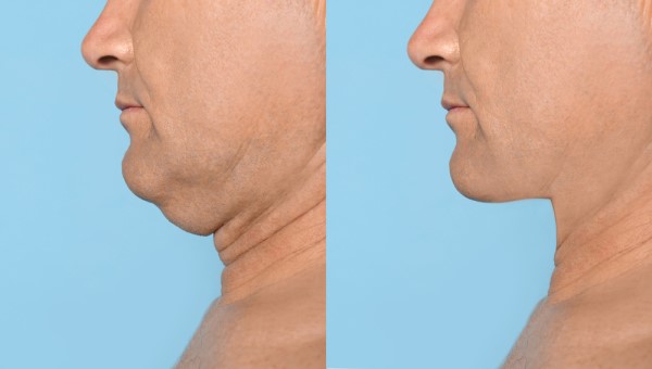 Which Non-Surgical Treatments Work Best for Jowls and Loose Skin Llanelli?