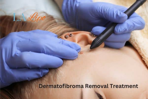 Dermatofibroma Removal Treatment Llanelli