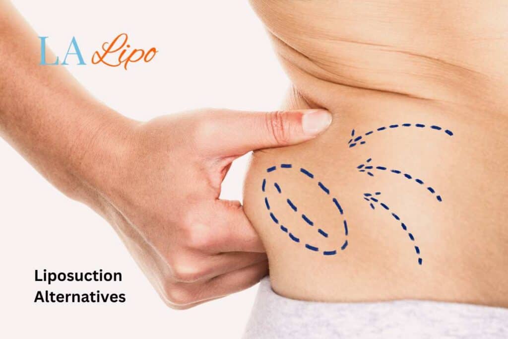 liposuction