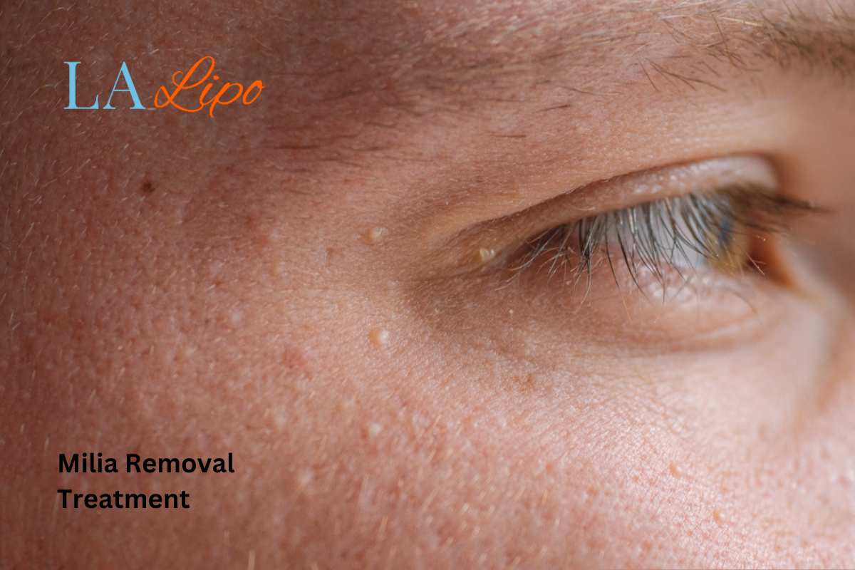 Cryopen Milia Removal: Is It the Easiest and Safest Option Llanelli?