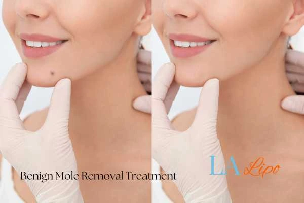 Before-and-after results following benign mole-removal treatment Llanelli