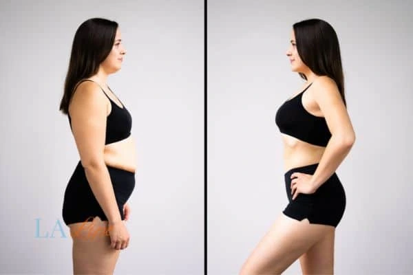 image of woman before and after results of LA-EMS Body Sculpting Llanelli to help treat Diastasis recti