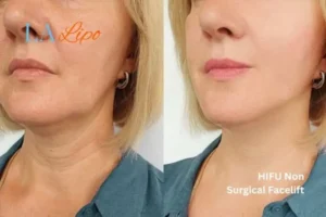 hi-fu for wrinkles Llanelli before and after results