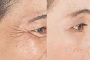 Before and after results of woman - HI-fu wrinkles reduction treatment Llanelli