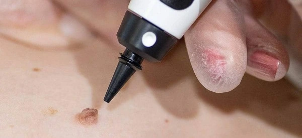 skin tag removal using cryopen Llanelli