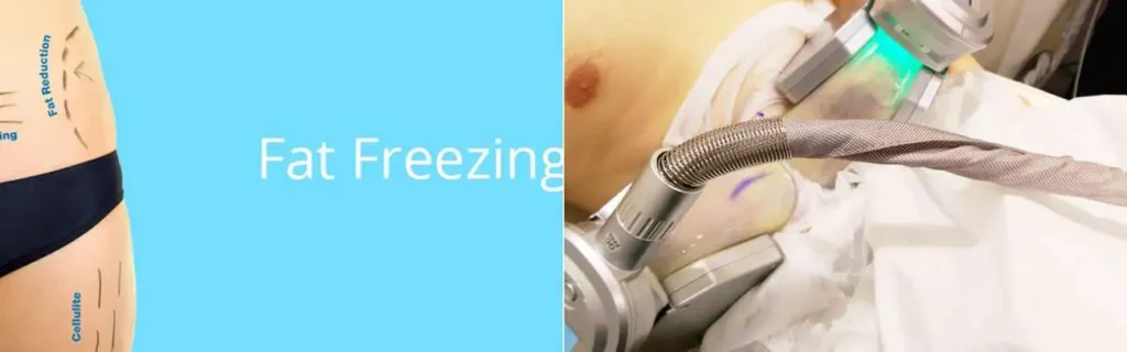 Fat freezing Llanelli on multiple areas of the body