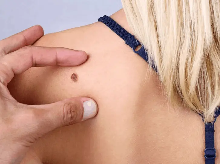 woman having mole removal Llanelli consultation before treatment.