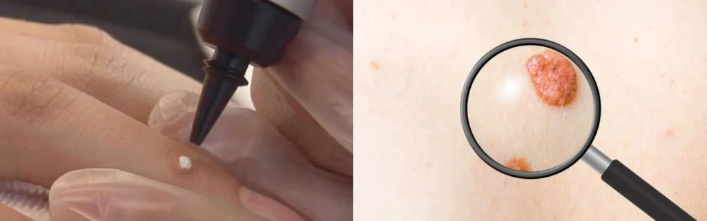 CryoPen practitioner Llanelli assessing a benign mole before treatment