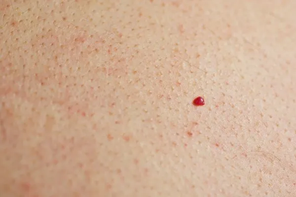 close up of a cherry angioma Llanelli