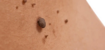 image of a skin tag Llanelli