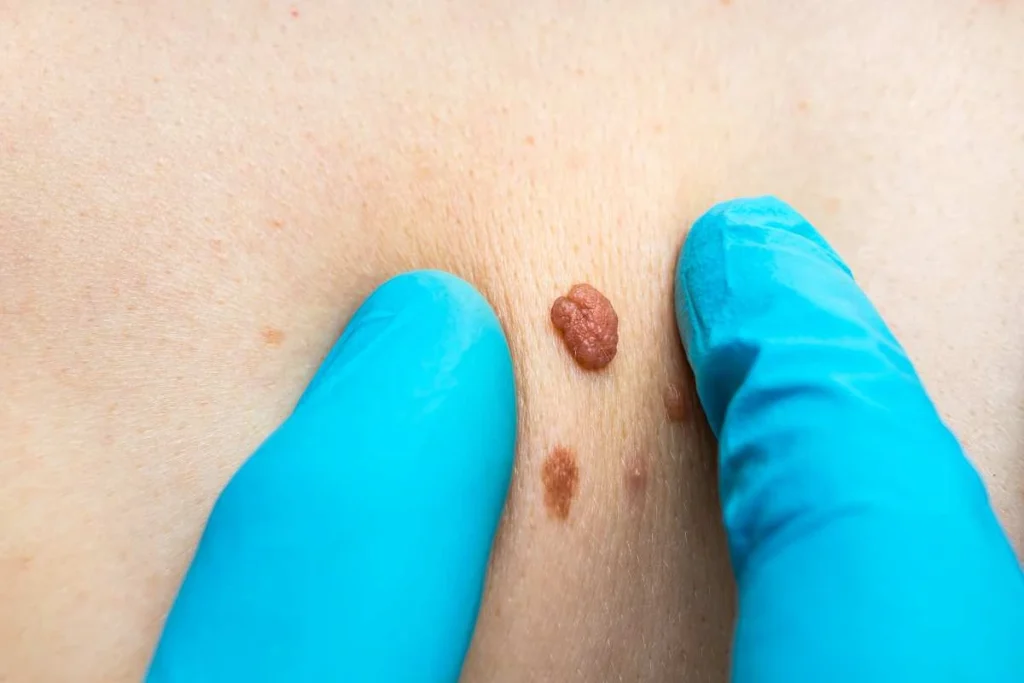 Consultant examining a skin tag Llanelli