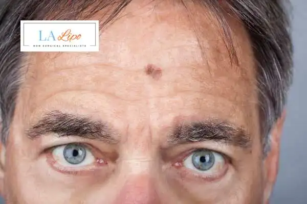 Solar Lentigo Removal Llanelli image of man with mark on his forehead