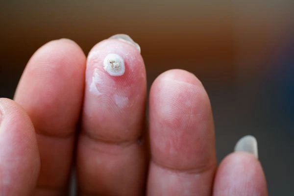 wart on person finger - cryotherapy to treat from LA LIPO Llanelli