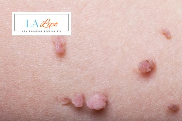 Does cryopen skin tag removal Llanelli hurt? Find out now call our team today!