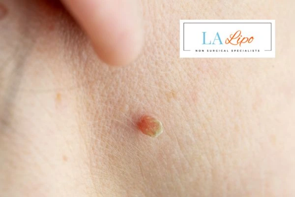 Book skin tag removal Llanelli today speak to our team now!