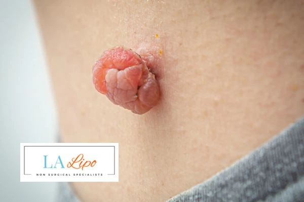 Interested in skin tag removal Llanelli? Concerned about the pain? Find out more today!
