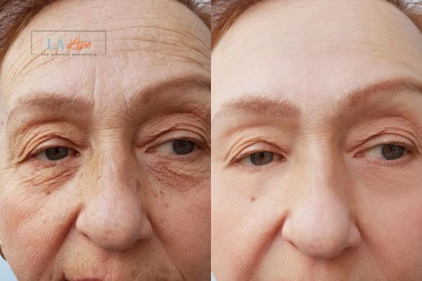 The powerful benefits of Morpheus8 Treatment Llanelli - Call Our team today!