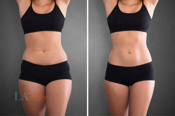 before and after results of non-surgical treatment to help a woman's body image and mental health Llanelli