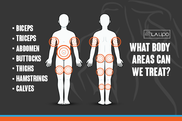 Diagram to show areas you can have LA-EMS Body Sculpting Treatment Llanelli