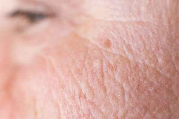 close up picture of a woman's face showing an age spot Llanelli