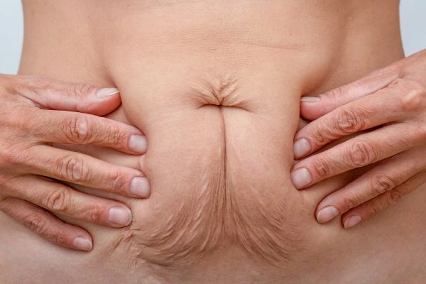 Should I Combine Diastasis Recti Treatment with Body Contouring for Better Results Llanelli?