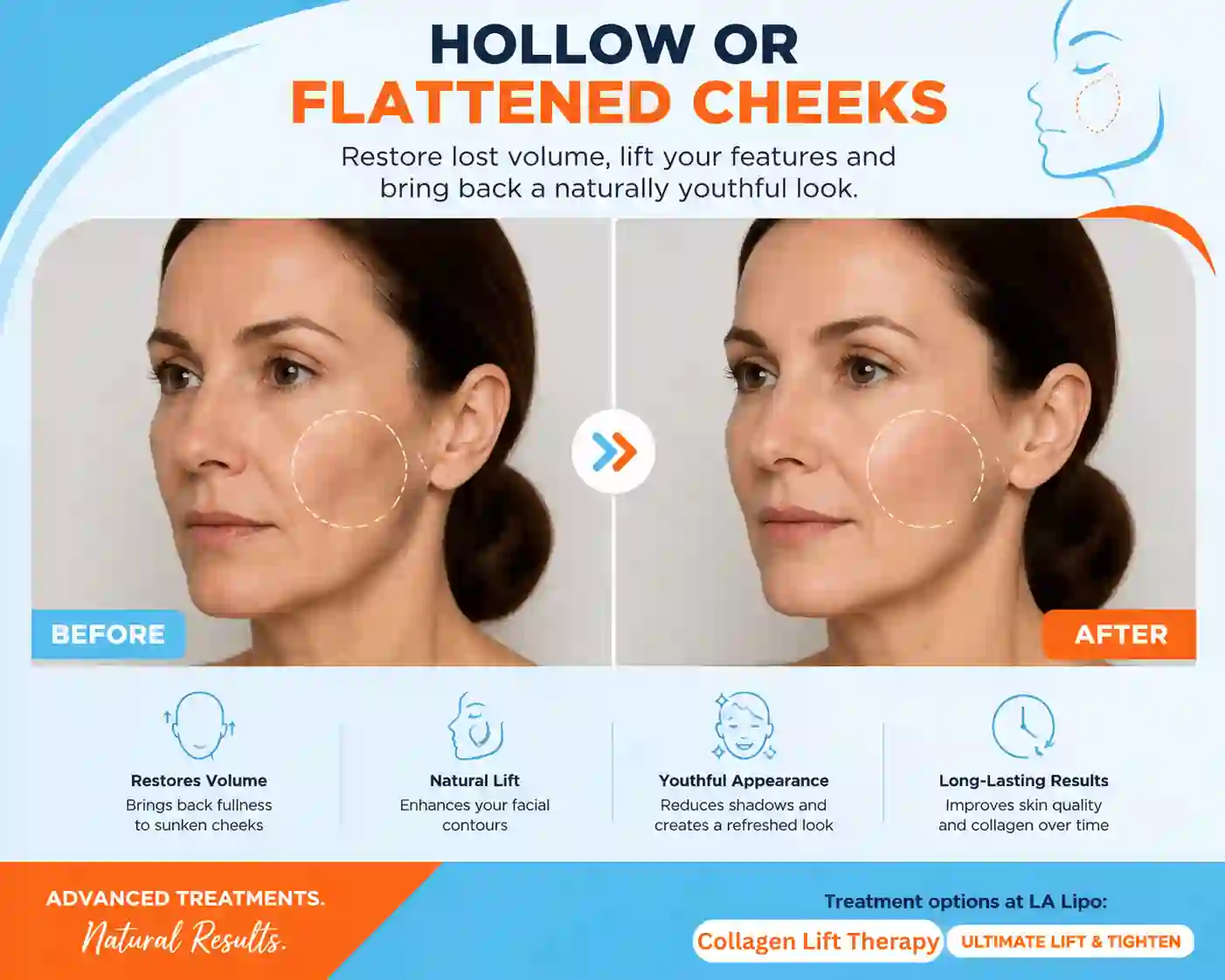 Sign #4: Hollow or Flattened Cheeks Llanelli