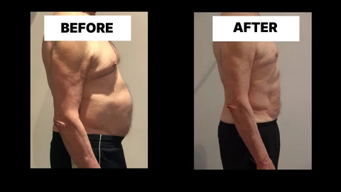 What Symptoms Can Diastasis Recti Cause in Men? Weak Core, Back Pain and Poor Posture Llanelli
